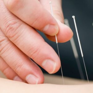 TERAPIA DE ACUPUNTURA 10 BONO SESIONES